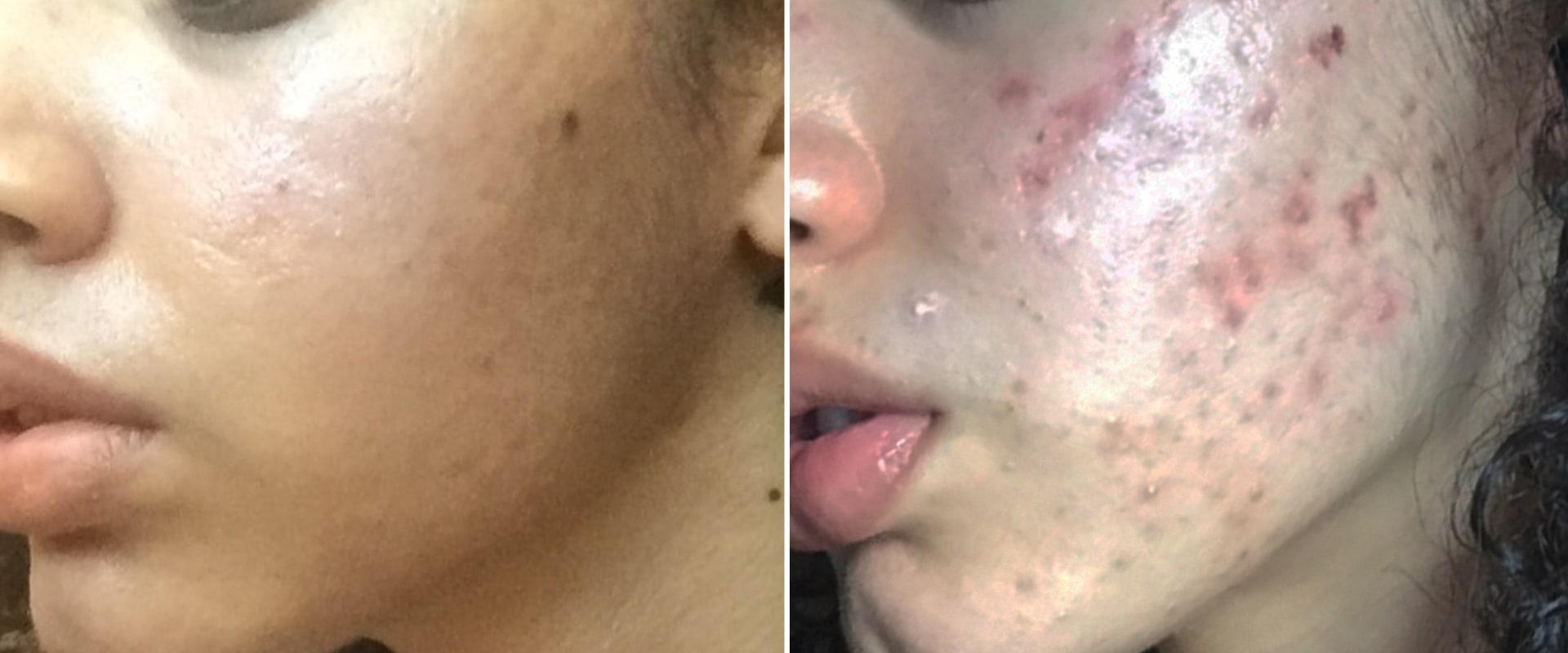 Does acne go away naturally?