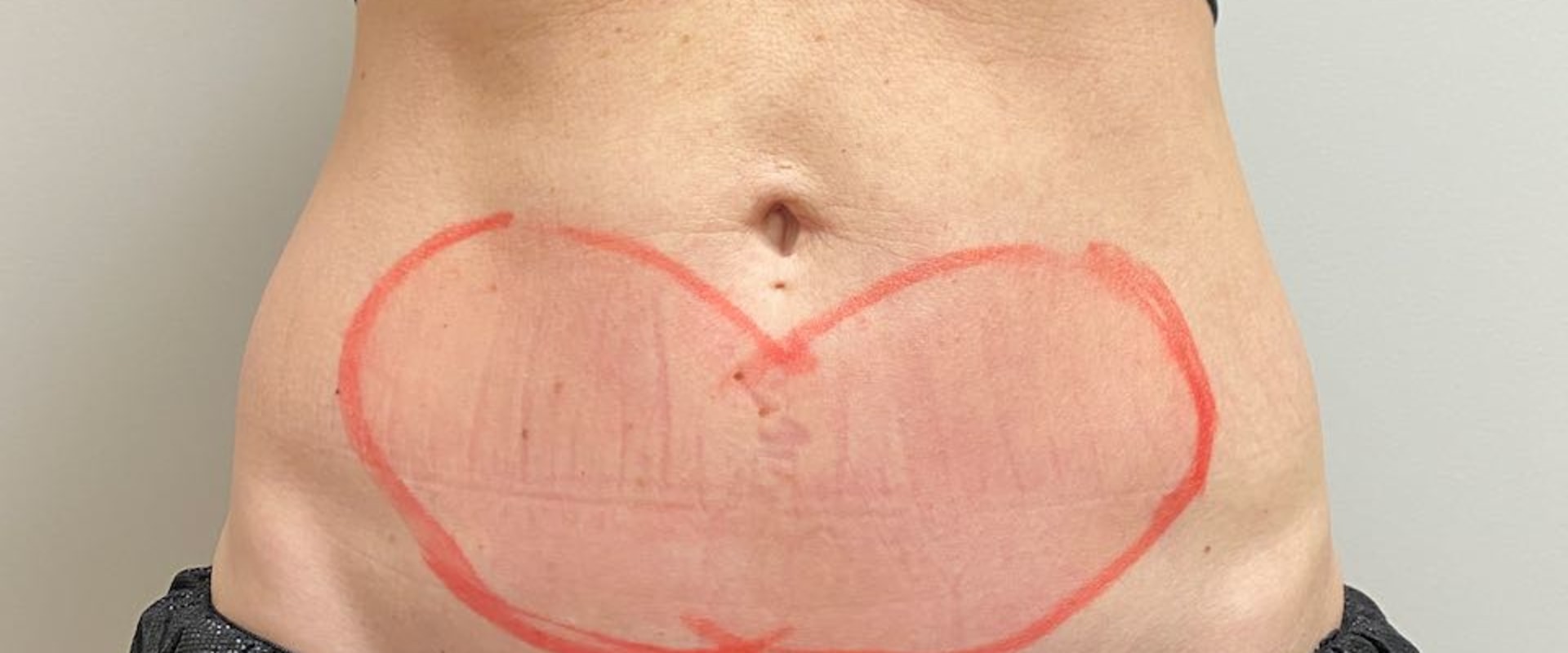 What does your skin look like after coolsculpting?