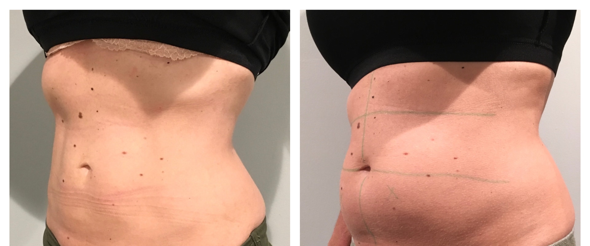 How much fat can coolsculpting remove in one session?