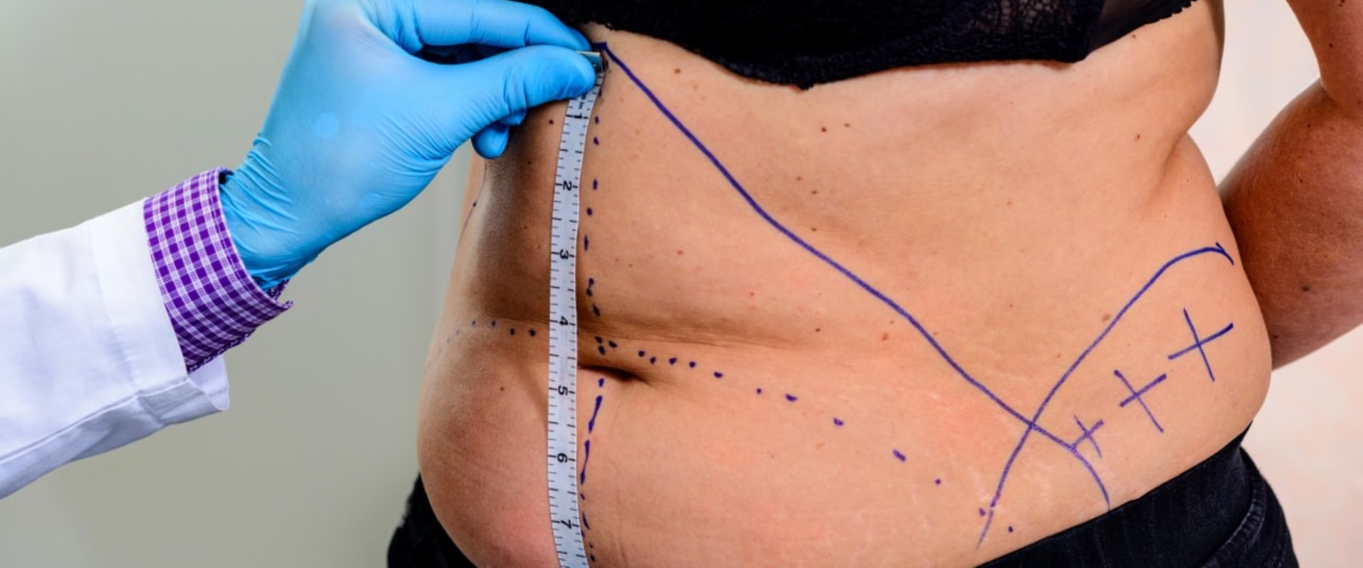 Understanding Liposuction: A Comprehensive Guide to Body Contouring