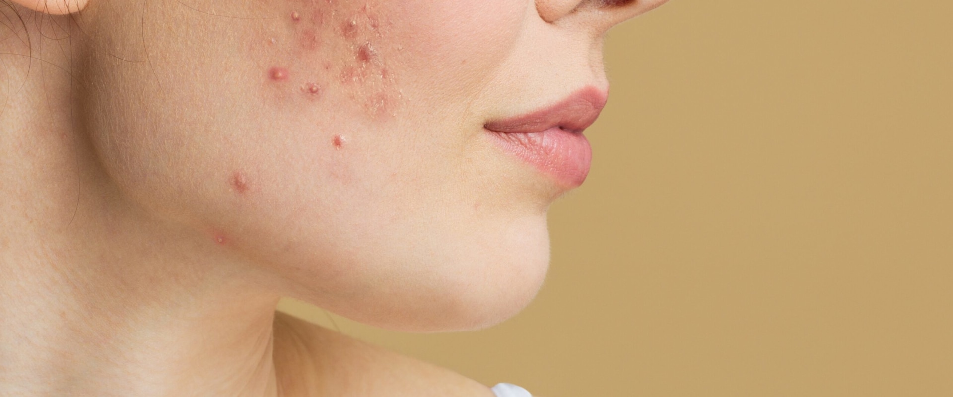 Will acne ever go away on its own?