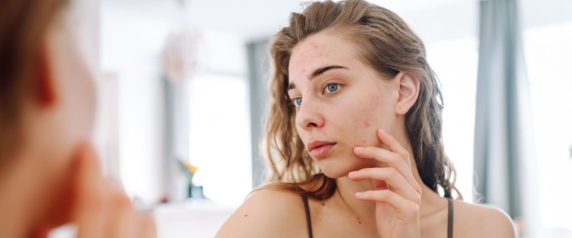 What is the most effective acne remover?