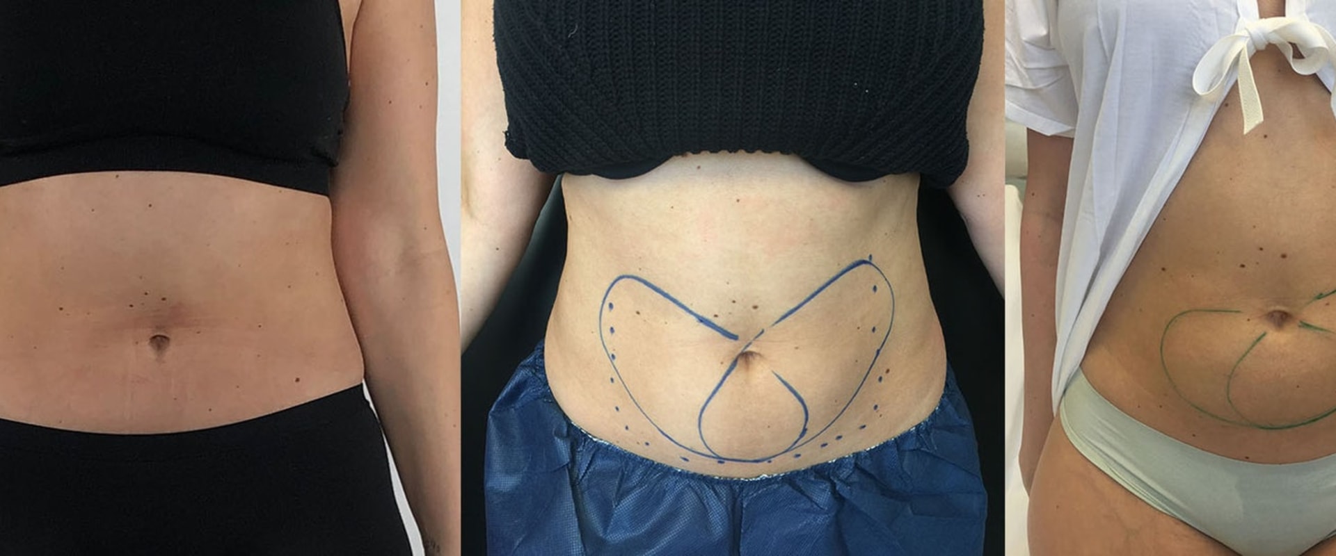 Is coolsculpting worth it for belly fat?