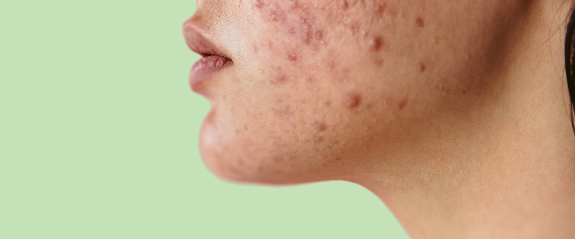 How long does acne normally last?