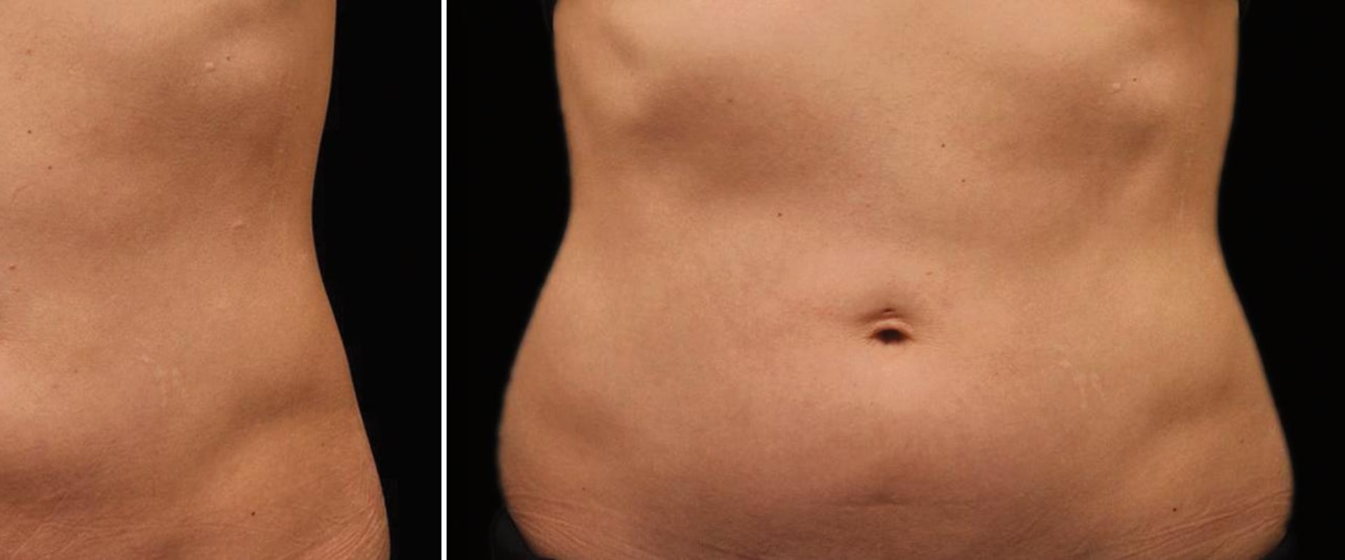 Can i lose 20 pounds with coolsculpting?