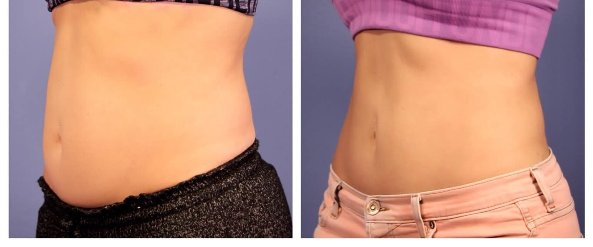 How often should i coolsculpt for belly fat?