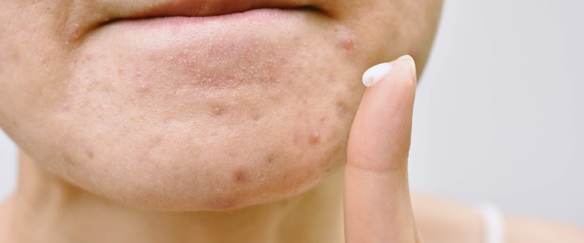 What is the most powerful acne treatment?