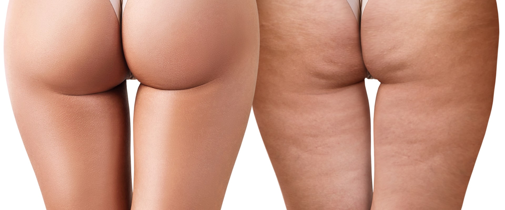 All About Cellulite Reduction: Non-Surgical Cosmetic Procedures for Healthy and Youthful Skin