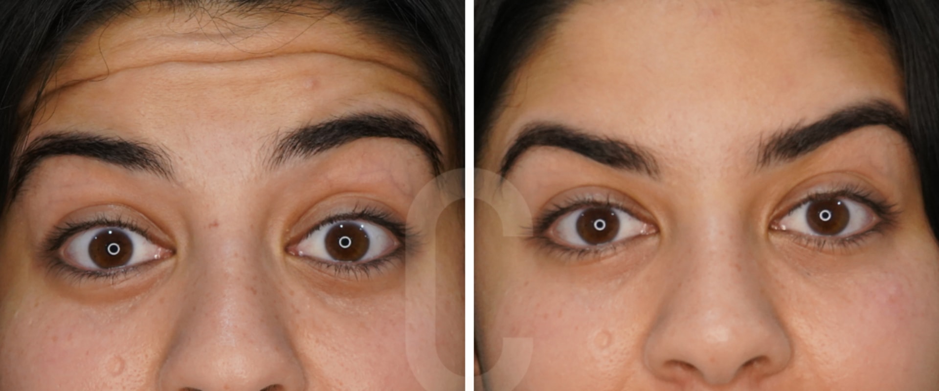 Understanding Forehead Wrinkles: Non-Surgical Cosmetic Procedures for Aging Concerns