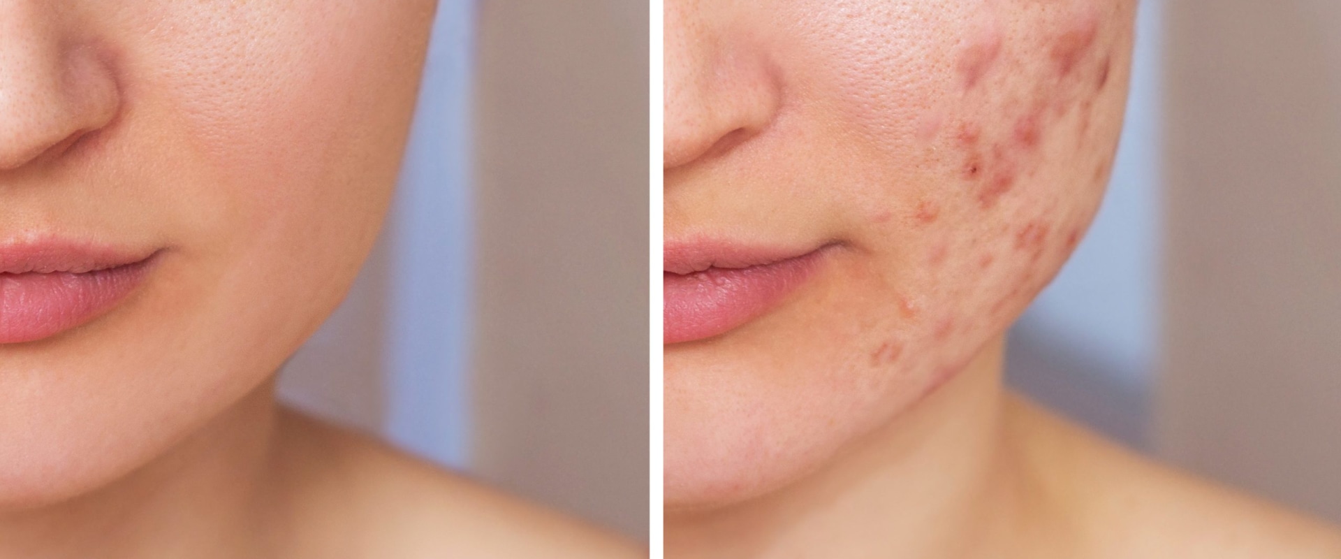 How to Improve Your Skin and Combat Acne with Non-Surgical Cosmetic Procedures