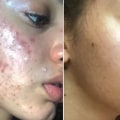 Does acne go away naturally?