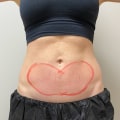 What does your skin look like after coolsculpting?