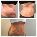 How much fat can coolsculpting remove in one session?