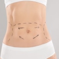 How many inches does coolsculpting take off?