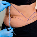 Understanding Liposuction: A Comprehensive Guide to Body Contouring