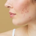 Will acne ever go away on its own?