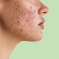 How long does acne normally last?