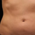 Can i lose 20 pounds with coolsculpting?