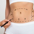 Can you tighten loose stomach skin?