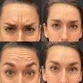 Understanding Botox Injections for Non-surgical Facial Procedures