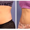 How often should i coolsculpt for belly fat?