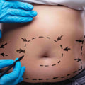 All You Need to Know About Tummy Tuck