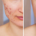 How to Improve Your Skin and Combat Acne with Non-Surgical Cosmetic Procedures