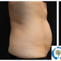 How deep does coolsculpting go?