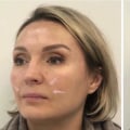 Understanding Nasolabial Folds: Non-Surgical Cosmetic Procedures for Skin Rejuvenation