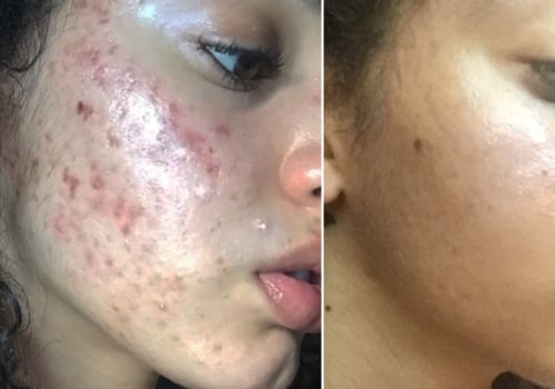 Does acne go away naturally?