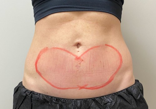 What does your skin look like after coolsculpting?