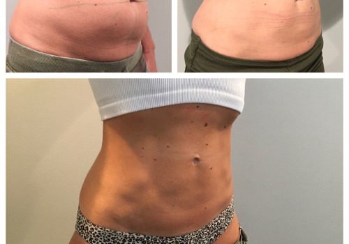 How much fat can coolsculpting remove in one session?