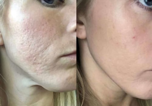 How do you get rid of acne permanently?