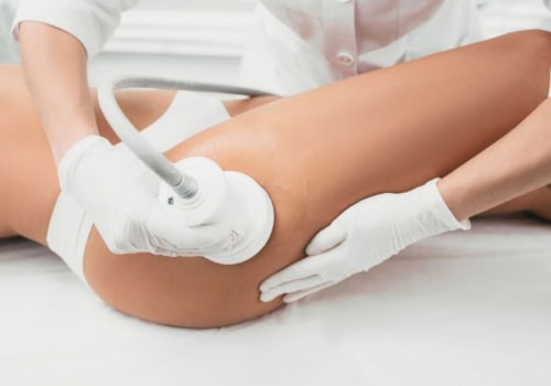 VelaShape: The Ultimate Non-Surgical Body Contouring Solution