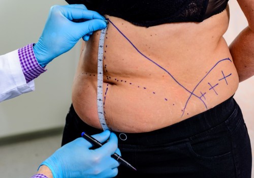 Understanding Liposuction: A Comprehensive Guide to Body Contouring