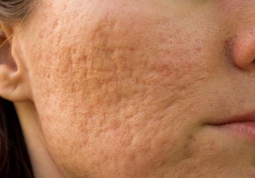 What makes face pimples go away?