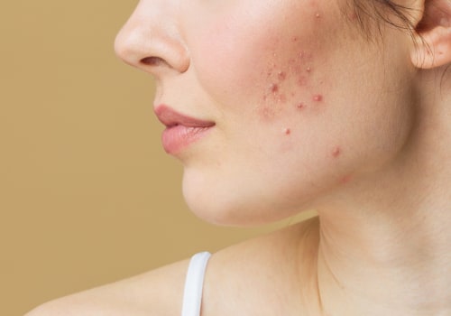 Will acne ever go away on its own?