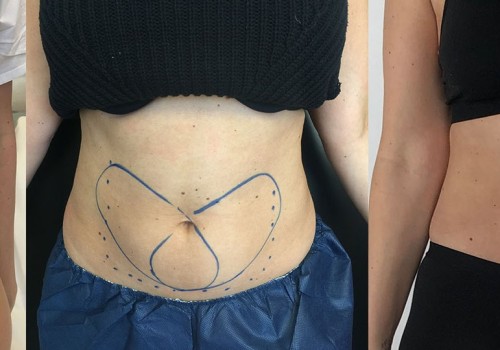 Is coolsculpting worth it for belly fat?