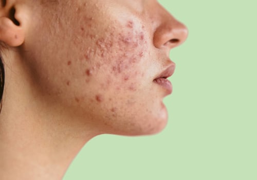 How long does acne normally last?