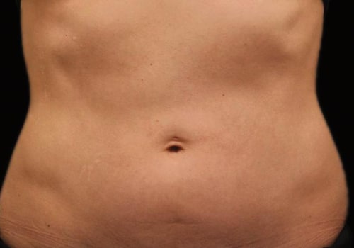 Can i lose 20 pounds with coolsculpting?