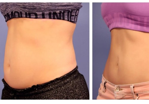 How often should i coolsculpt for belly fat?