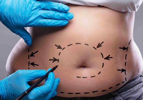 All You Need to Know About Tummy Tuck