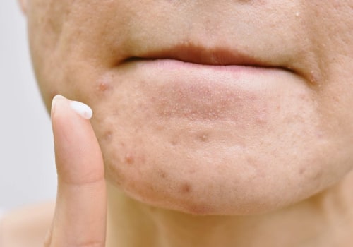 What is the most powerful acne treatment?