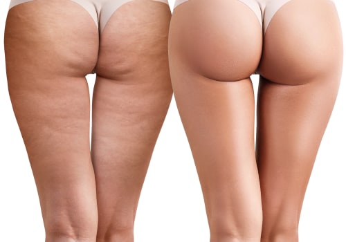 All About Cellulite Reduction: Non-Surgical Cosmetic Procedures for Healthy and Youthful Skin