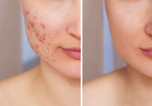 How to Improve Your Skin and Combat Acne with Non-Surgical Cosmetic Procedures