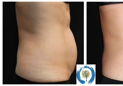 How deep does coolsculpting go?