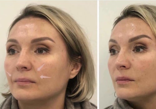 Understanding Nasolabial Folds: Non-Surgical Cosmetic Procedures for Skin Rejuvenation